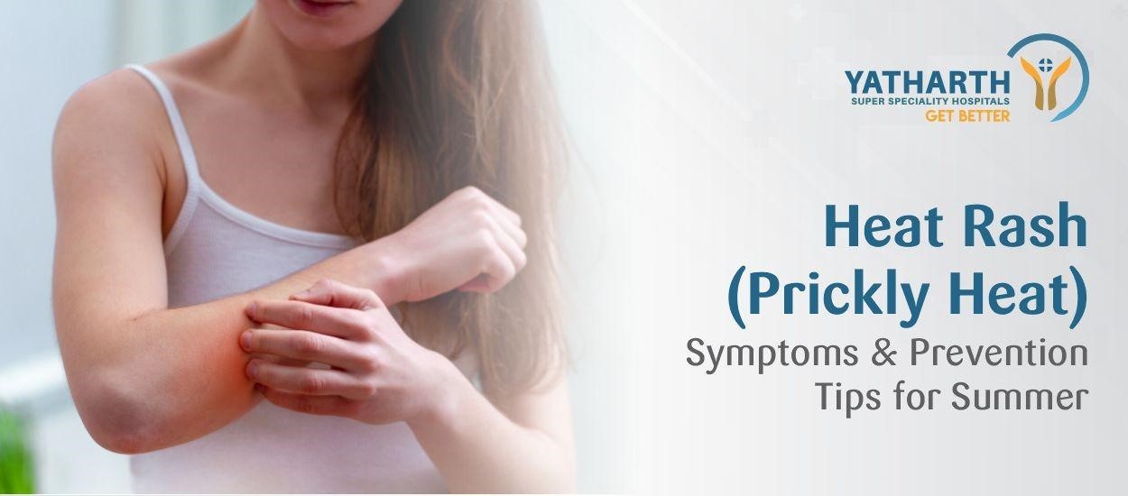 Heat Rash (Prickly Heat) During Summer: Causes, Symptoms, Remedies and Prevention