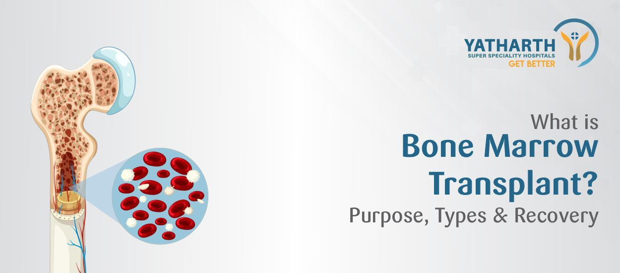 What Is Bone Marrow Transplant? Purpose, Types & Recovery