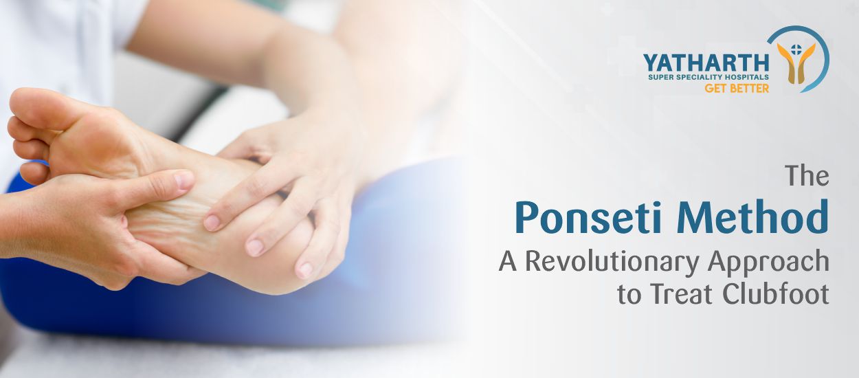 The Ponseti Method: A Revolutionary  Approach to Treat Clubfoot