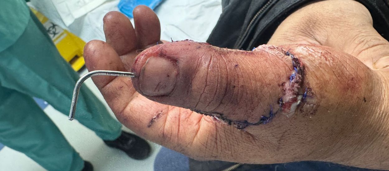 Yatharth Hospital Doctors Reattach Severed Thumb Using Microsurgery