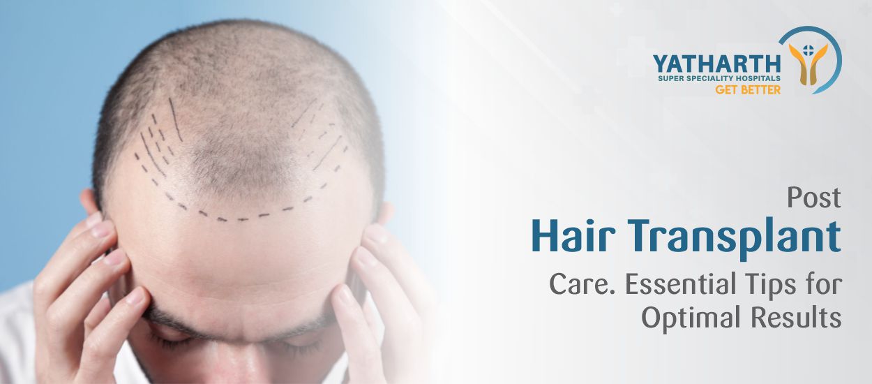 Post-Hair Transplant Care: Essential Tips for Optimal Results