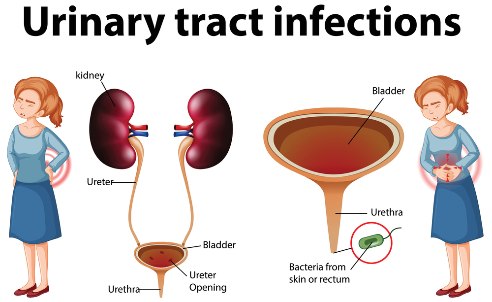 Urinary Tract Infections Symptoms And Treatment