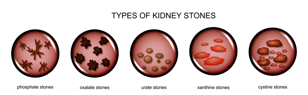 kidney-stones-causes-symptoms-and-treatment-options-yatharth-hospitals